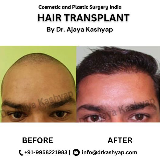 Best Hair Transplant Delhi - Indian Directory