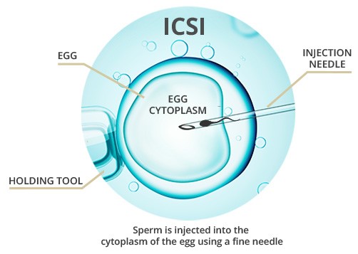 The Ultimate Guide to Intracytoplasmic Sperm Injection (ICSI) in Delhi