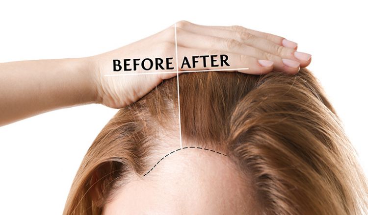 Woman before and after hair-loss treatment on white background